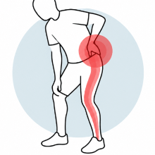 Sciatica Symptoms