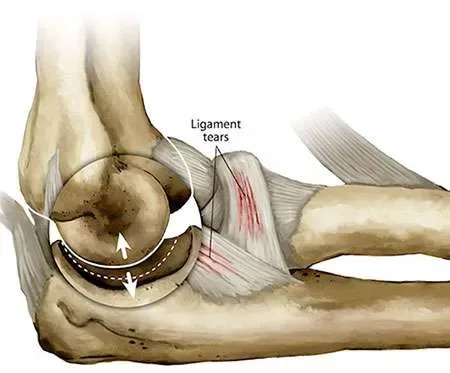 Elbow Pain Therapy London