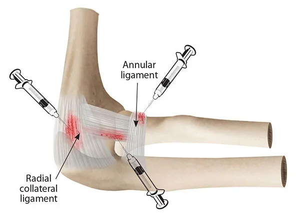 Elbow Pain Mobile