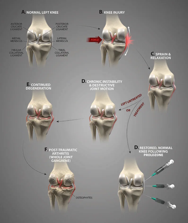 How Ligaments and Tendons Injuries Lead to Degenerative Arthritis Mobile
