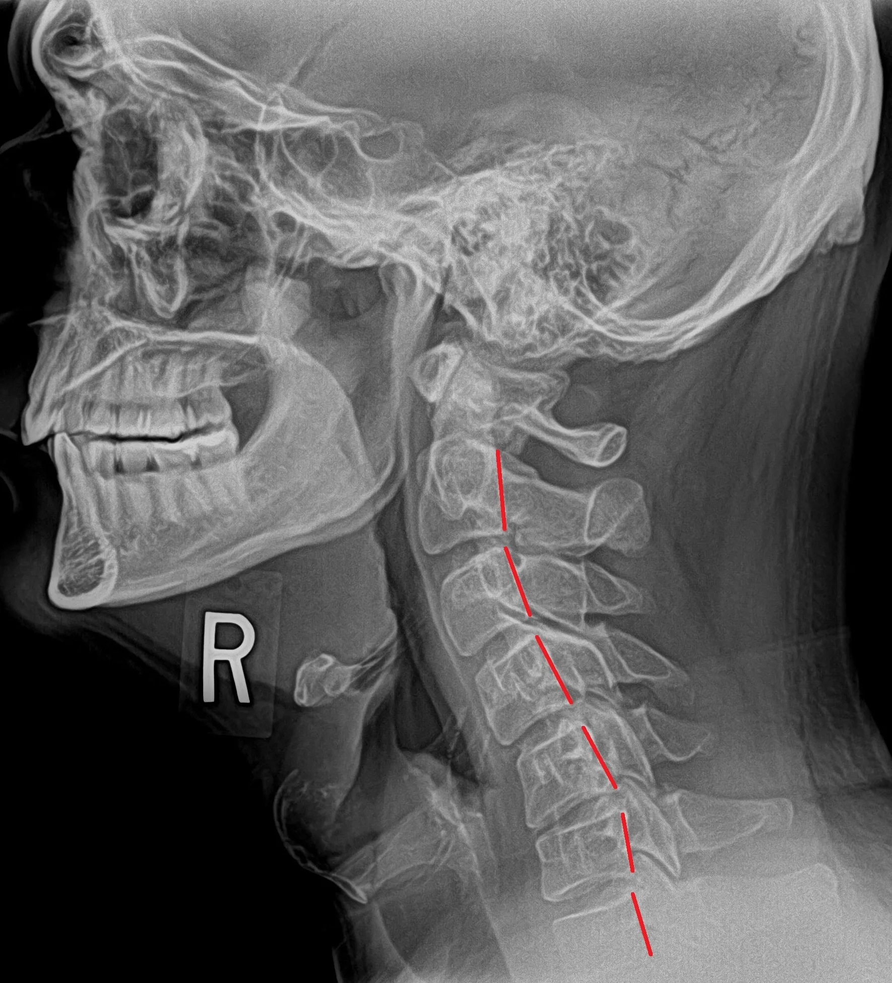 Cervical Neck Pain Treatment London
