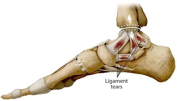 Ankle & Achilles Treatment London