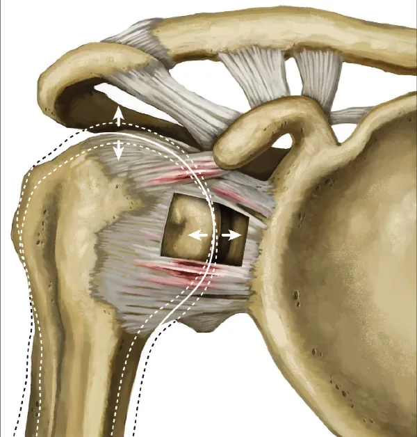 Shoulder Pain London