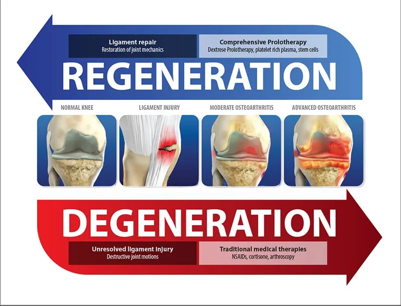 Prolotherapy for Arthritic Pain Mobile